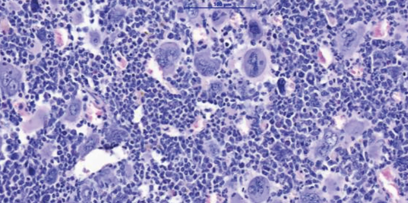 MPN sind durch eine Expansion des blutbildenden Systems im Knochenmark charakterisiert. Dies führt zum Anstieg verschiedener Zellreihen und im Endzustand dann zur Knochenmarksvernarbung und auch akuten Leukämie. MPN.jpg