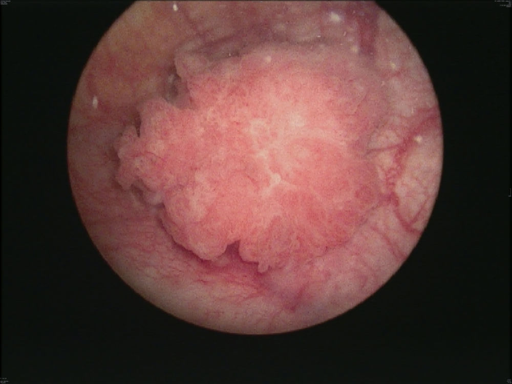 BU: Zytoskopie (Blasenspiegelung) mit endoskopischer Darstellung eines 3 Zentimeter großen Blasentumors. ©R. Pichler