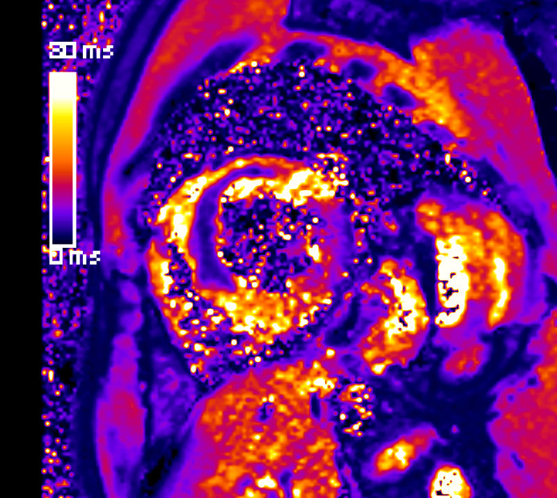 BU: MRT-Bild eines Vorderwandinfarktes mit ausgedehnter intramyokardialer Einblutung. © Kardiologie Innsbruck
